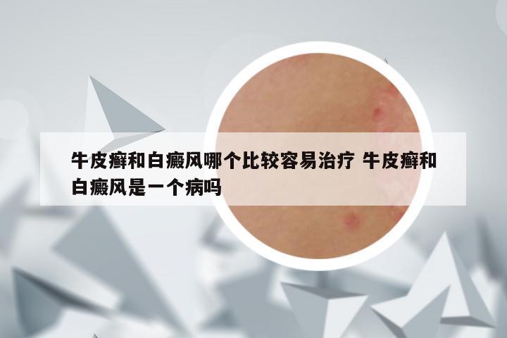 牛皮癣和白癜风哪个比较容易治疗 牛皮癣和白癜风是一个病吗