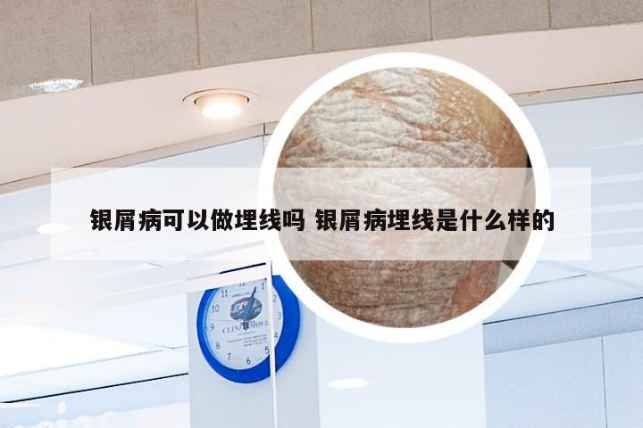银屑病可以做埋线吗 银屑病埋线是什么样的