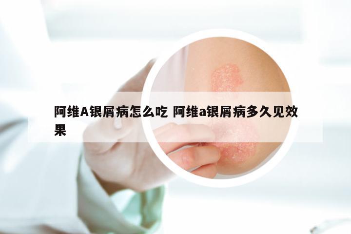 阿维A银屑病怎么吃 阿维a银屑病多久见效果