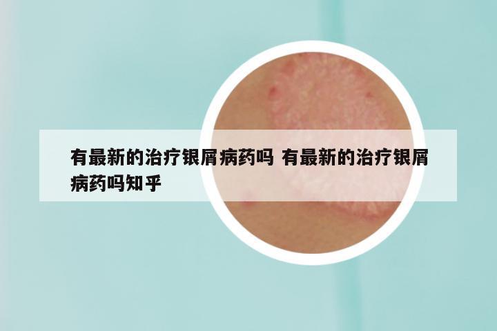 有最新的治疗银屑病药吗 有最新的治疗银屑病药吗知乎