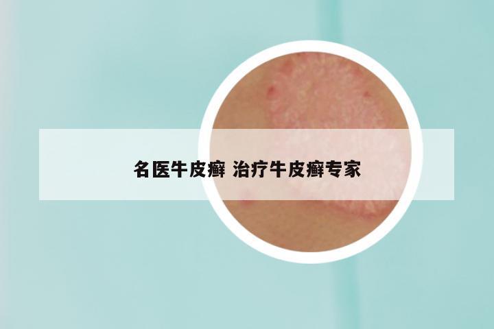 名医牛皮癣 治疗牛皮癣专家