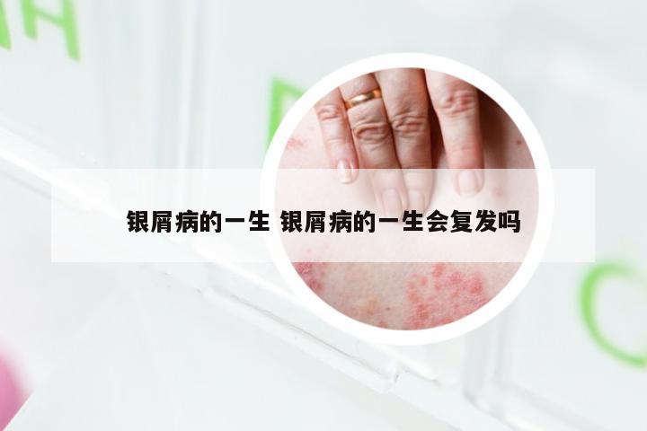 银屑病的一生 银屑病的一生会复发吗