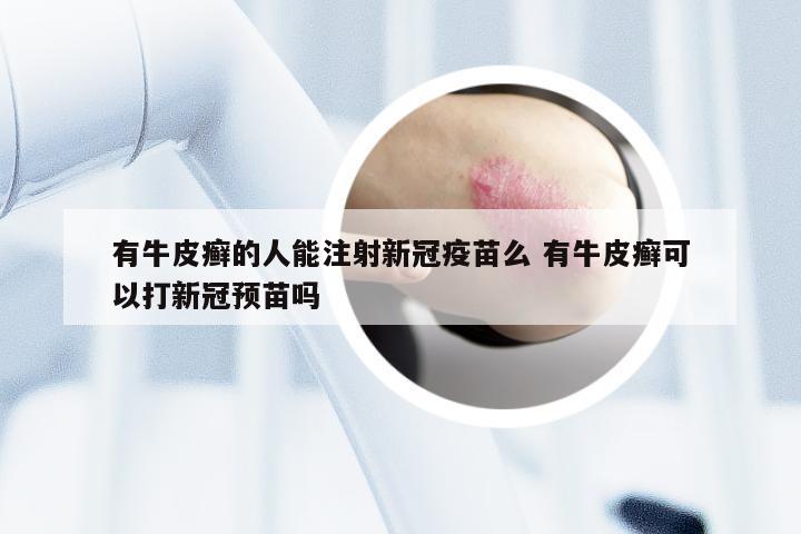 有牛皮癣的人能注射新冠疫苗么 有牛皮癣可以打新冠预苗吗