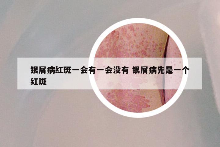 银屑病红斑一会有一会没有 银屑病先是一个红斑