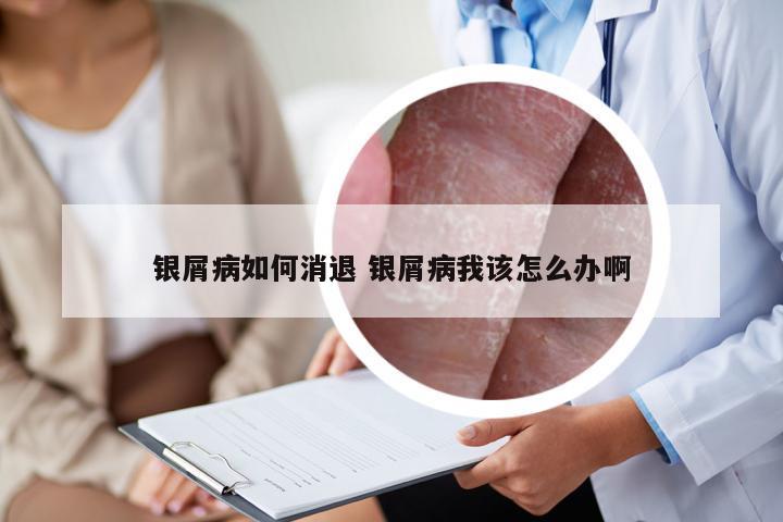 银屑病如何消退 银屑病我该怎么办啊