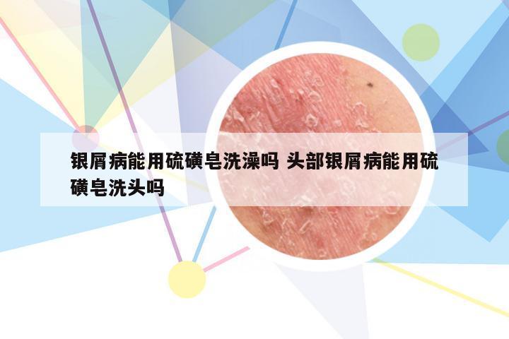 银屑病能用硫磺皂洗澡吗 头部银屑病能用硫磺皂洗头吗