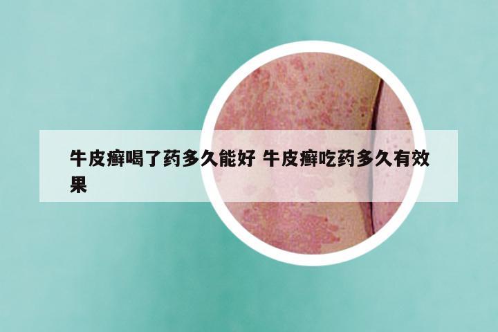 牛皮癣喝了药多久能好 牛皮癣吃药多久有效果