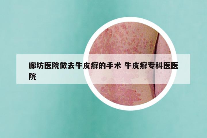 廊坊医院做去牛皮癣的手术 牛皮癣专科医医院