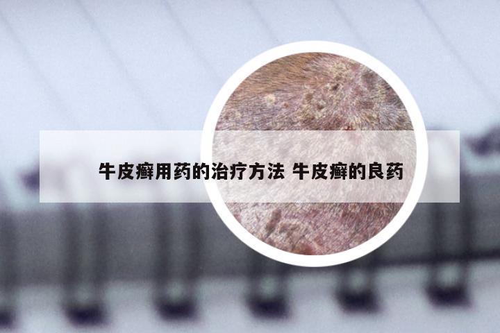 牛皮癣用药的治疗方法 牛皮癣的良药