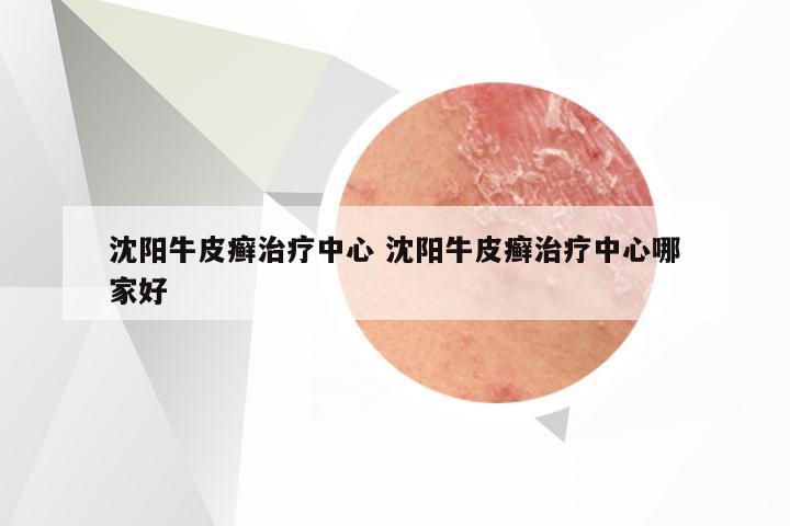 沈阳牛皮癣治疗中心 沈阳牛皮癣治疗中心哪家好