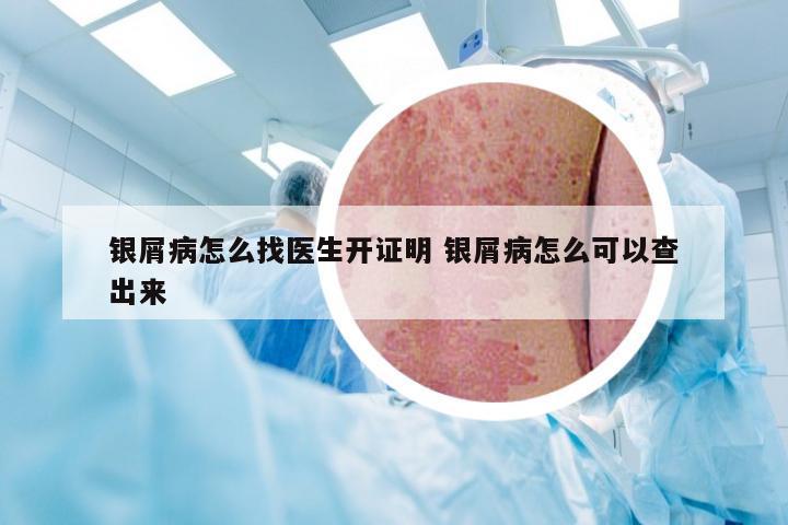 银屑病怎么找医生开证明 银屑病怎么可以查出来