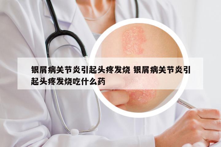 银屑病关节炎引起头疼发烧 银屑病关节炎引起头疼发烧吃什么药