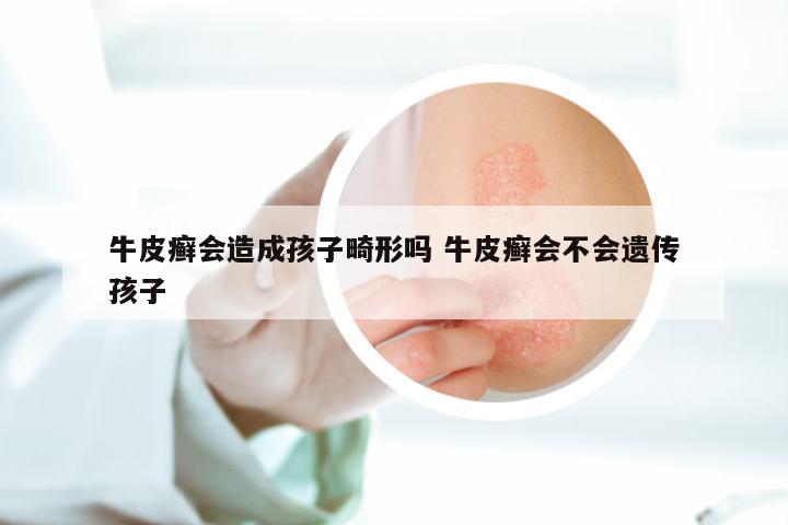 牛皮癣会造成孩子畸形吗 牛皮癣会不会遗传孩子