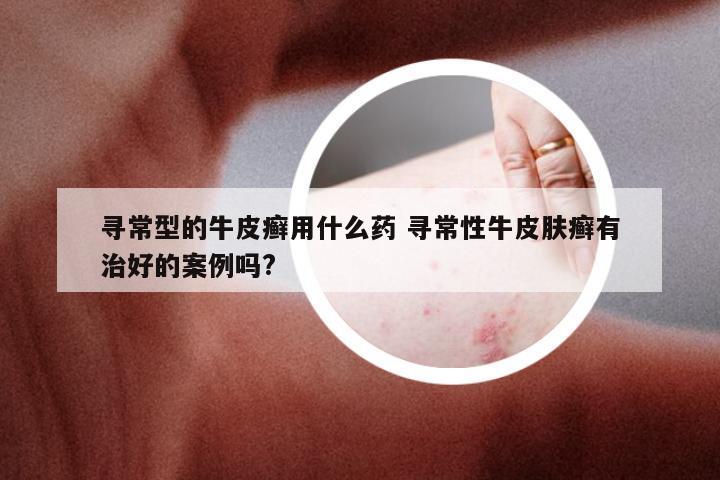 寻常型的牛皮癣用什么药 寻常性牛皮肤癣有治好的案例吗?