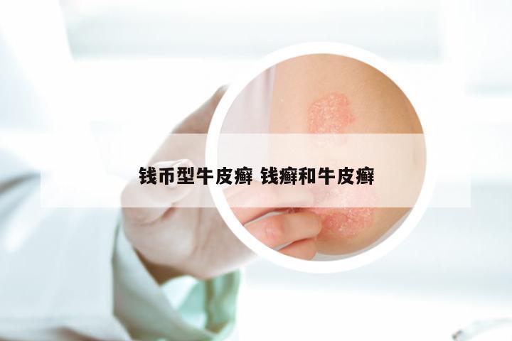 钱币型牛皮癣 钱癣和牛皮癣