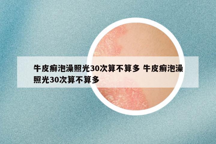 牛皮癣泡澡照光30次算不算多 牛皮癣泡澡照光30次算不算多