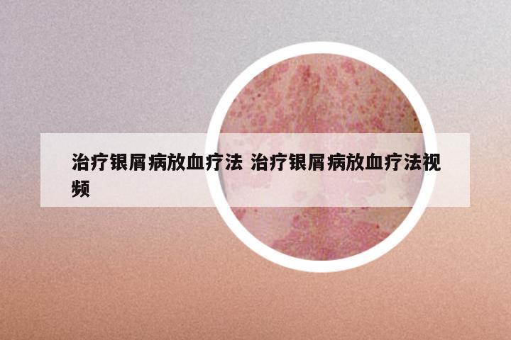 治疗银屑病放血疗法 治疗银屑病放血疗法视频