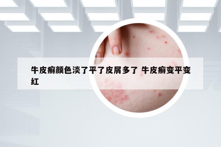 牛皮癣颜色淡了平了皮屑多了 牛皮癣变平变红