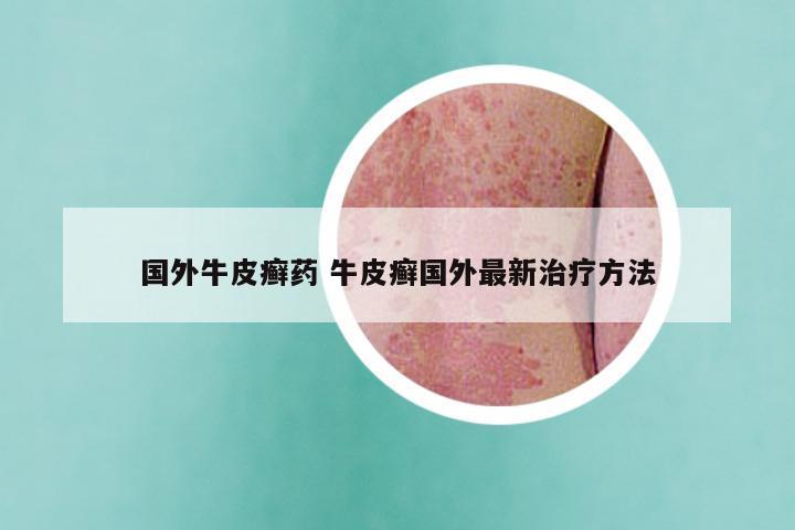 国外牛皮癣药 牛皮癣国外最新治疗方法