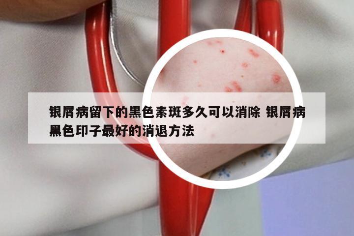 银屑病留下的黑色素斑多久可以消除 银屑病黑色印子最好的消退方法