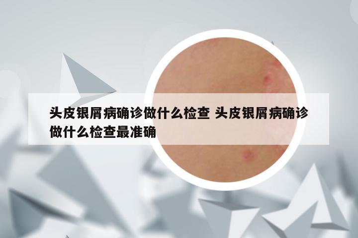 头皮银屑病确诊做什么检查 头皮银屑病确诊做什么检查最准确