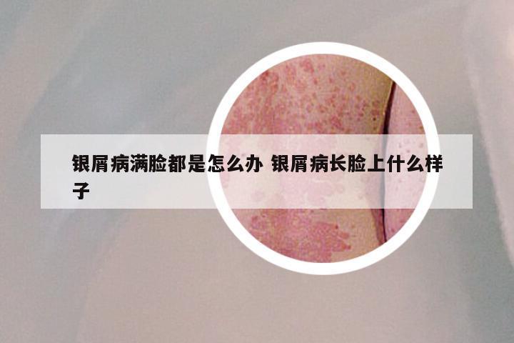 银屑病满脸都是怎么办 银屑病长脸上什么样子