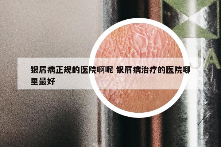 银屑病正规的医院啊呢 银屑病治疗的医院哪里最好