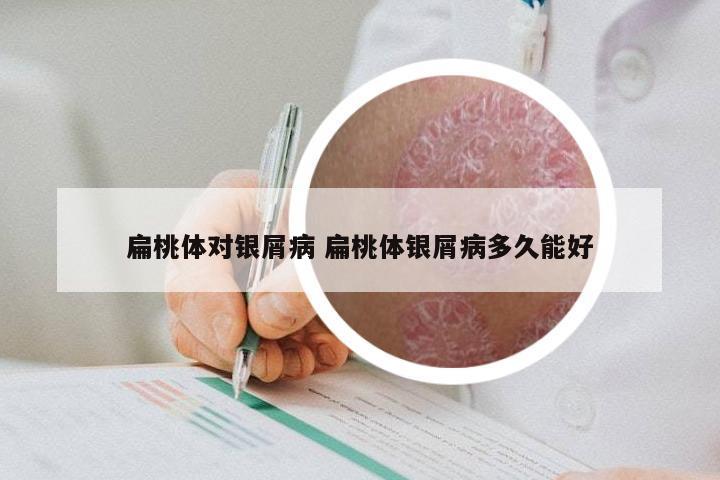 扁桃体对银屑病 扁桃体银屑病多久能好