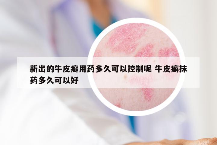 新出的牛皮癣用药多久可以控制呢 牛皮癣抹药多久可以好