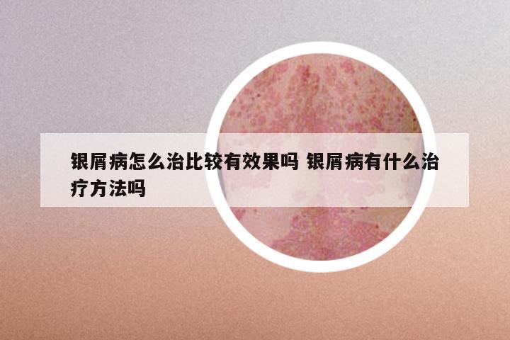 银屑病怎么治比较有效果吗 银屑病有什么治疗方法吗