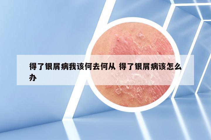 得了银屑病我该何去何从 得了银屑病该怎么办