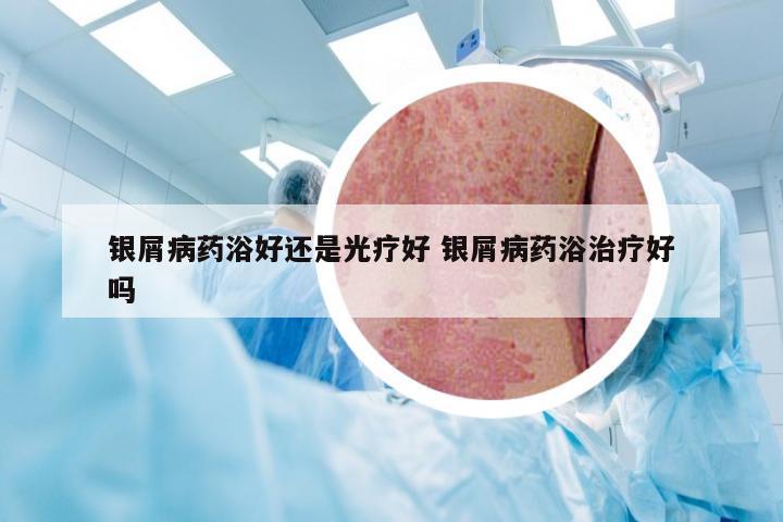 银屑病药浴好还是光疗好 银屑病药浴治疗好吗