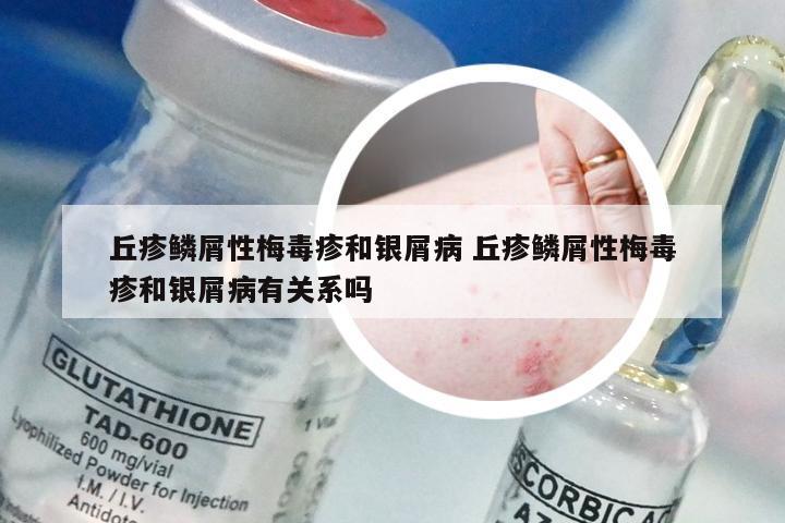 丘疹鳞屑性梅毒疹和银屑病 丘疹鳞屑性梅毒疹和银屑病有关系吗