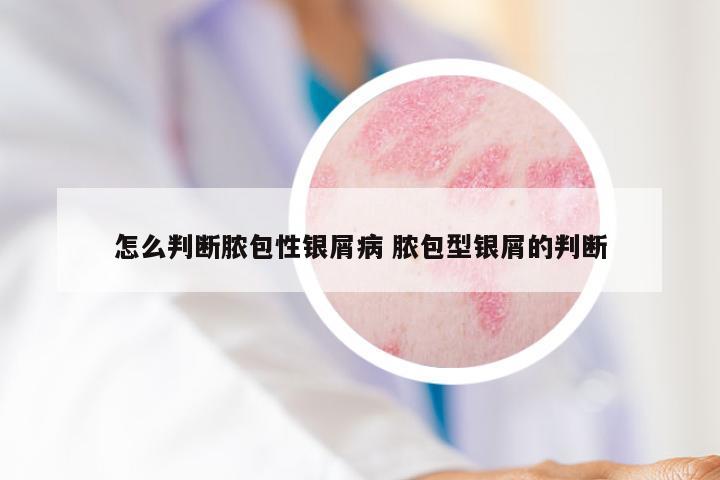 怎么判断脓包性银屑病 脓包型银屑的判断