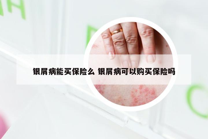 银屑病能买保险么 银屑病可以购买保险吗