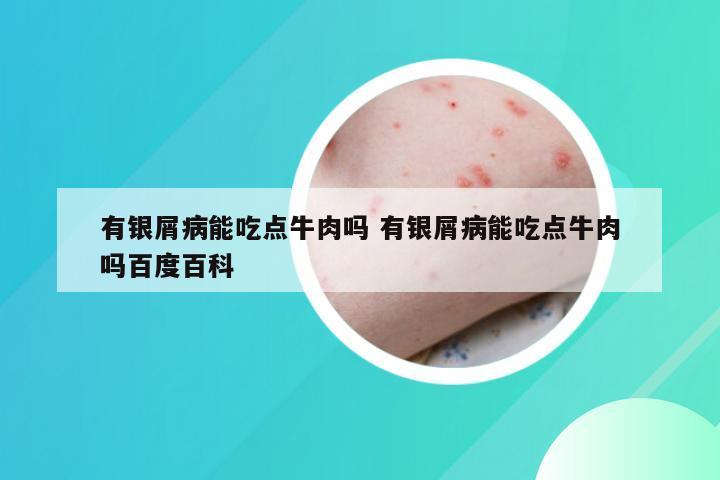 有银屑病能吃点牛肉吗 有银屑病能吃点牛肉吗百度百科