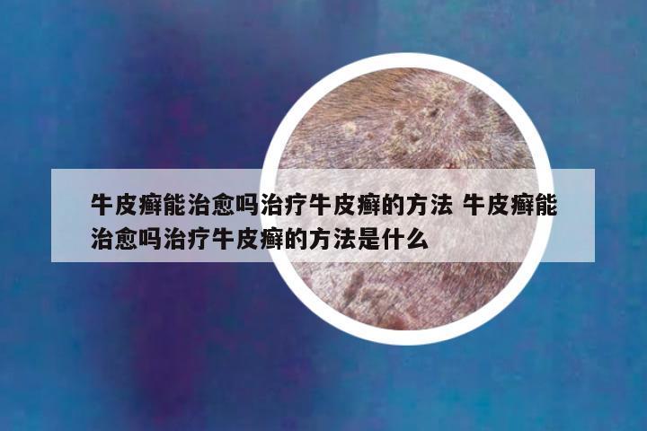 牛皮癣能治愈吗治疗牛皮癣的方法 牛皮癣能治愈吗治疗牛皮癣的方法是什么
