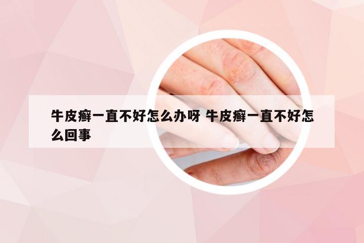 牛皮癣一直不好怎么办呀 牛皮癣一直不好怎么回事