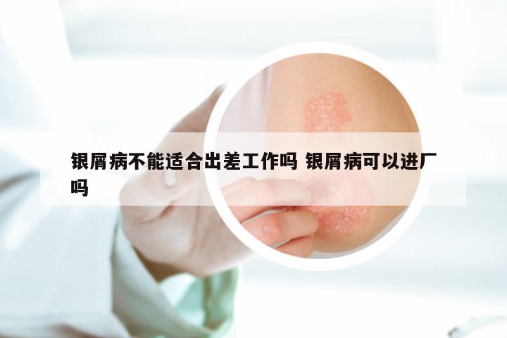 银屑病不能适合出差工作吗 银屑病可以进厂吗