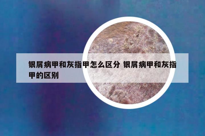银屑病甲和灰指甲怎么区分 银屑病甲和灰指甲的区别