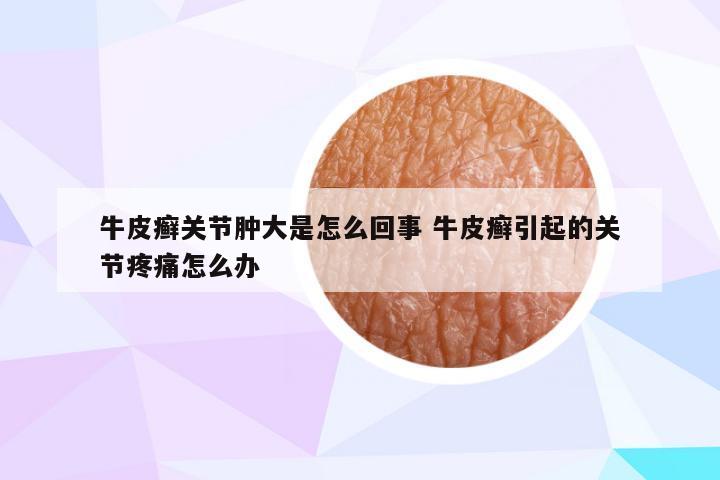 牛皮癣关节肿大是怎么回事 牛皮癣引起的关节疼痛怎么办