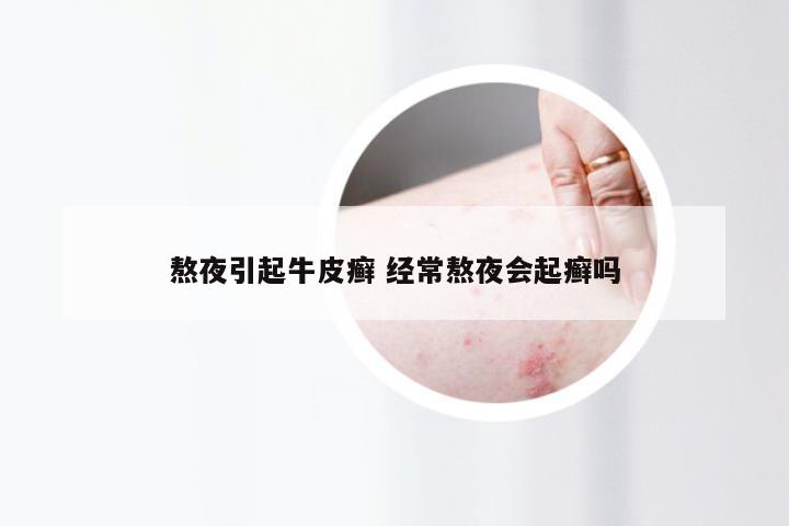 熬夜引起牛皮癣 经常熬夜会起癣吗