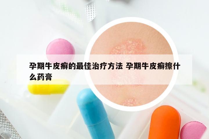 孕期牛皮癣的最佳治疗方法 孕期牛皮癣擦什么药膏