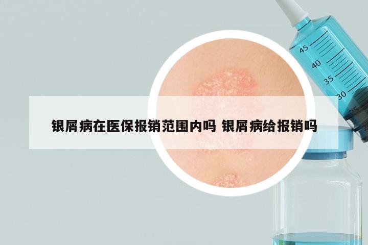银屑病在医保报销范围内吗 银屑病给报销吗