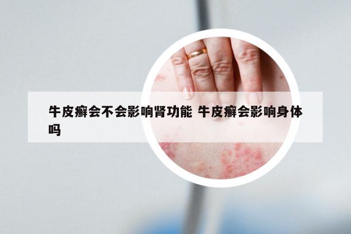 牛皮癣会不会影响肾功能 牛皮癣会影响身体吗