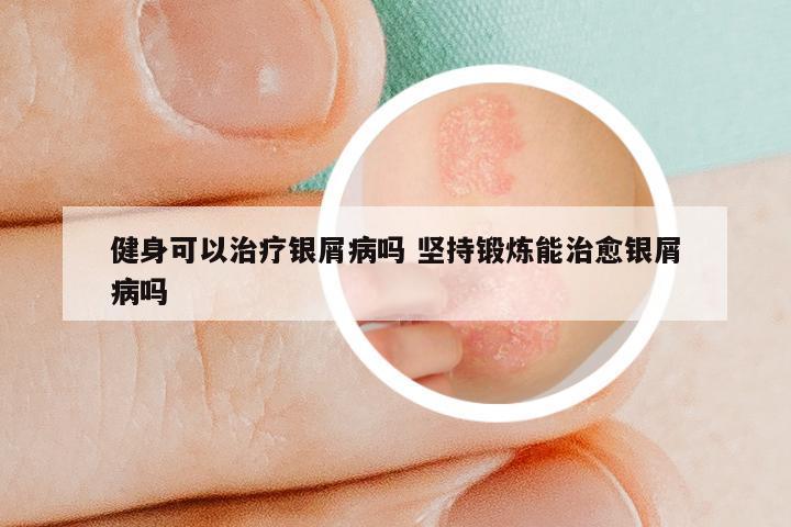 健身可以治疗银屑病吗 坚持锻炼能治愈银屑病吗