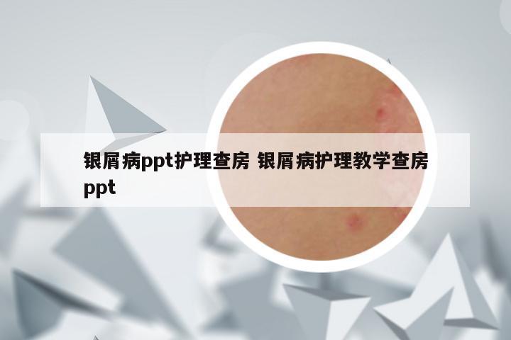 银屑病ppt护理查房 银屑病护理教学查房ppt