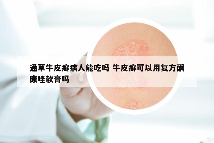 通草牛皮癣病人能吃吗 牛皮癣可以用复方酮康唑软膏吗
