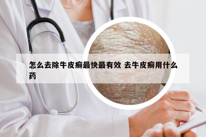 怎么去除牛皮癣最快最有效 去牛皮癣用什么药