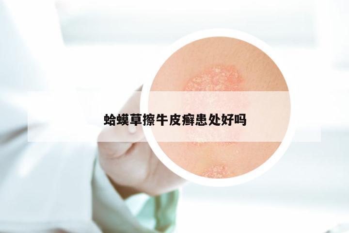 蛤蟆草擦牛皮癣患处好吗